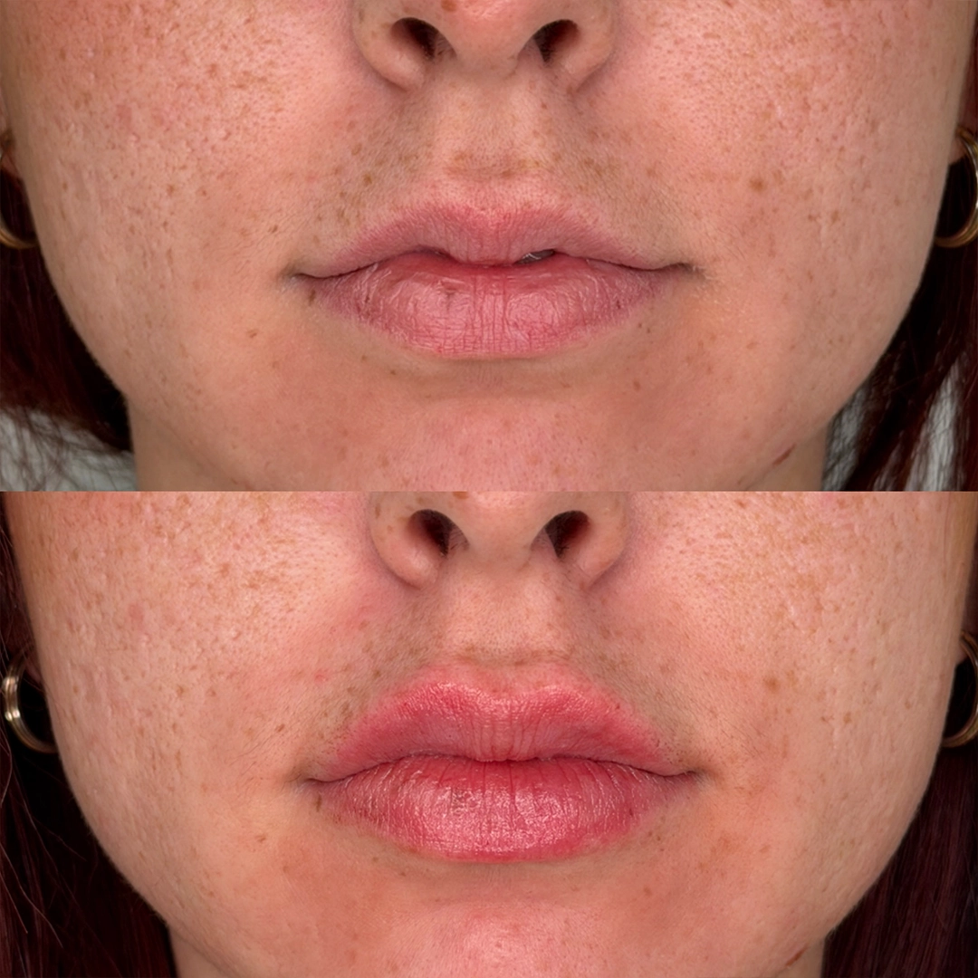 Dermal Filler 32 Lip Filler Before & After 12