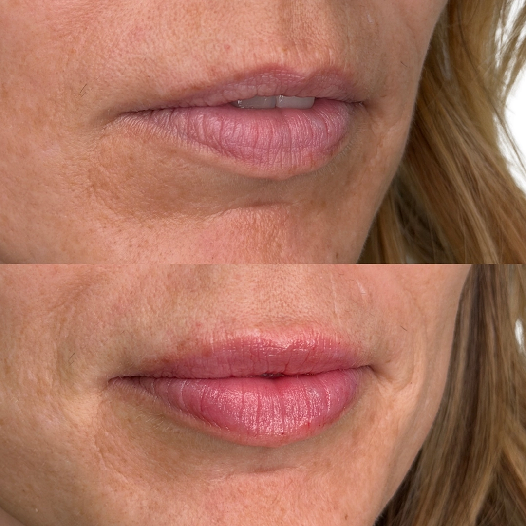 Dermal Filler 33 Lip Filler Before & After 13