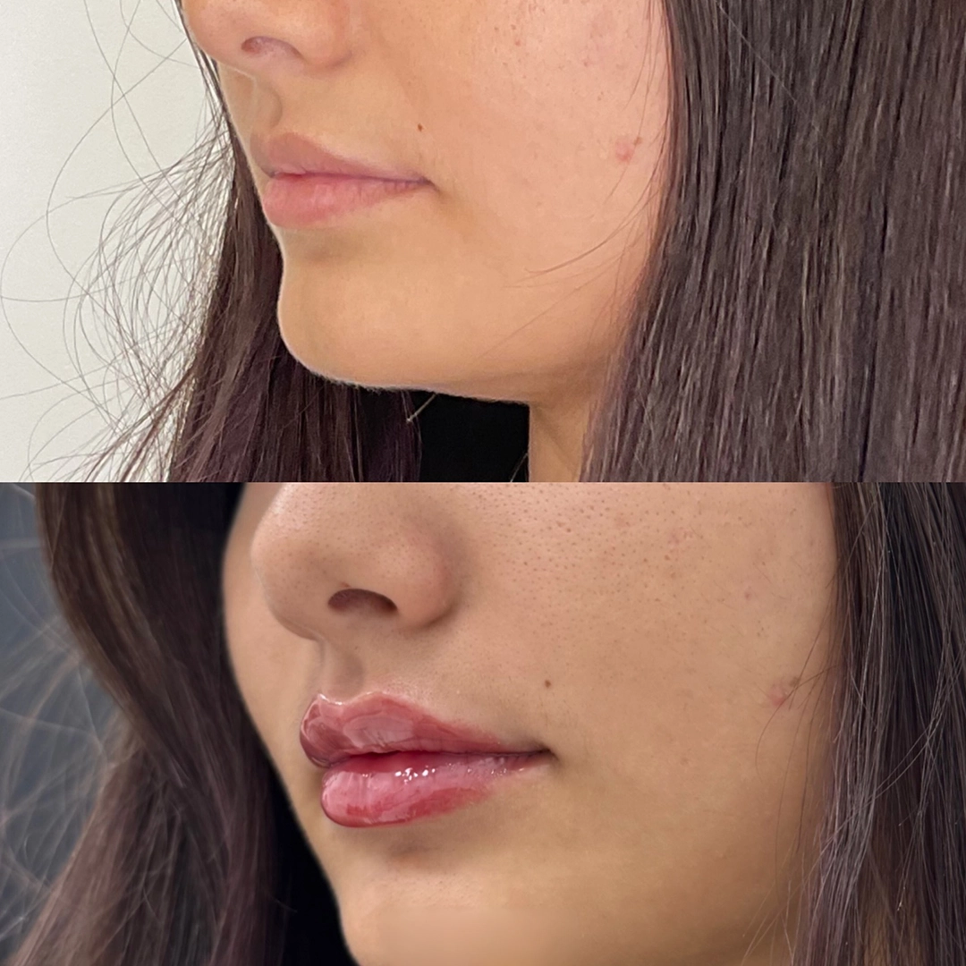 Dermal Filler 34 Lip Filler Before & After 14