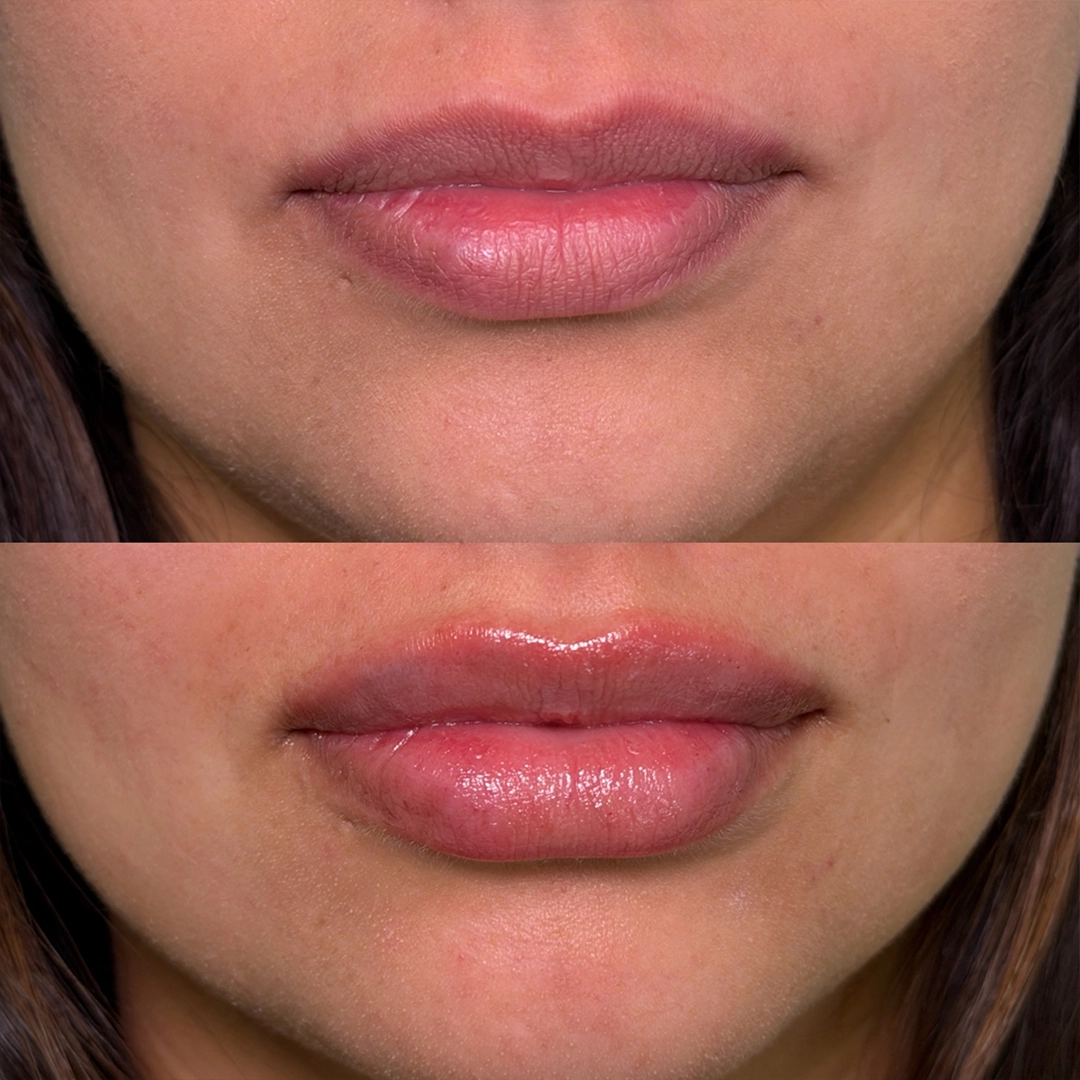 Dermal Filler 35 Lip Filler Before & After 15