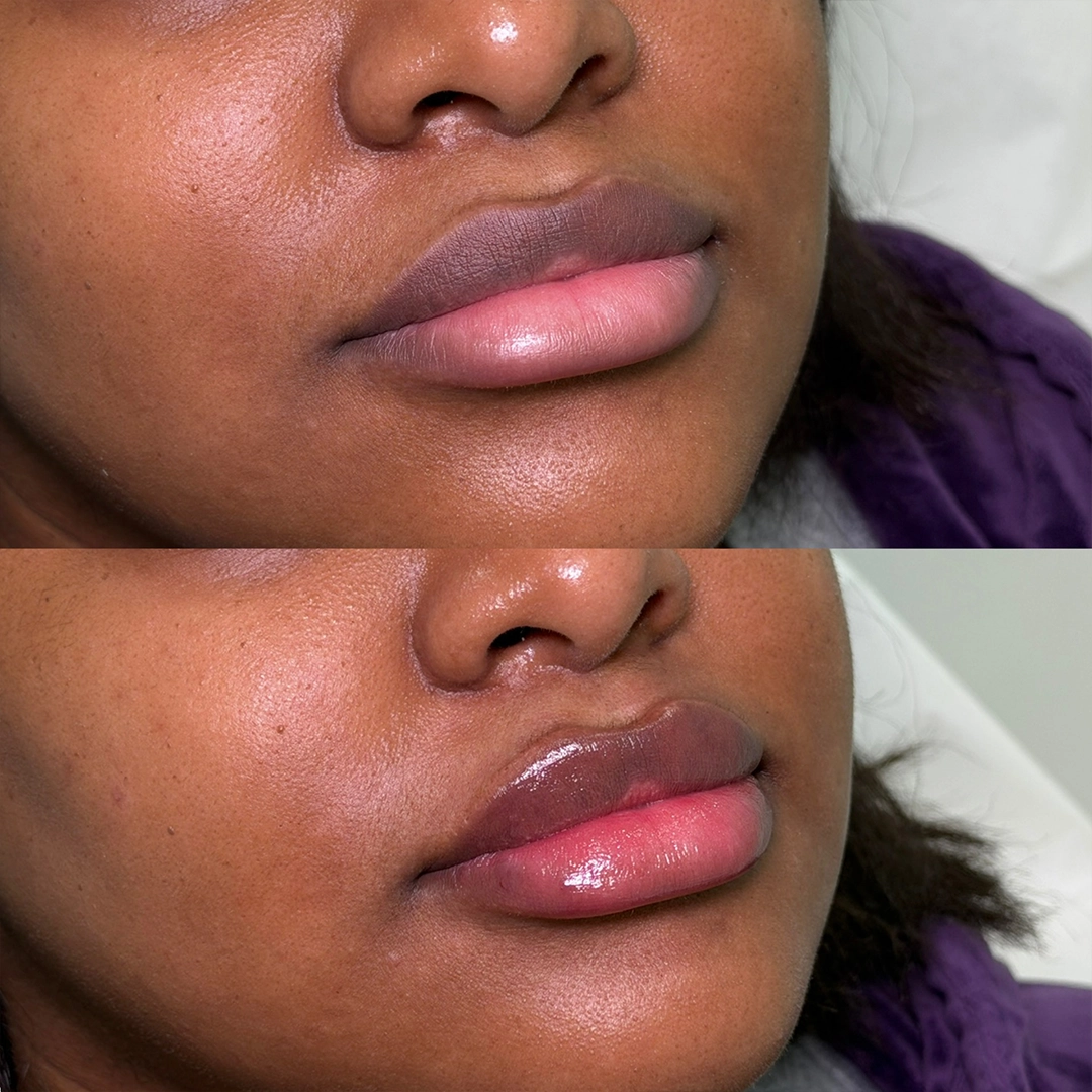 Dermal Filler 36 Lip Filler Before & After 16