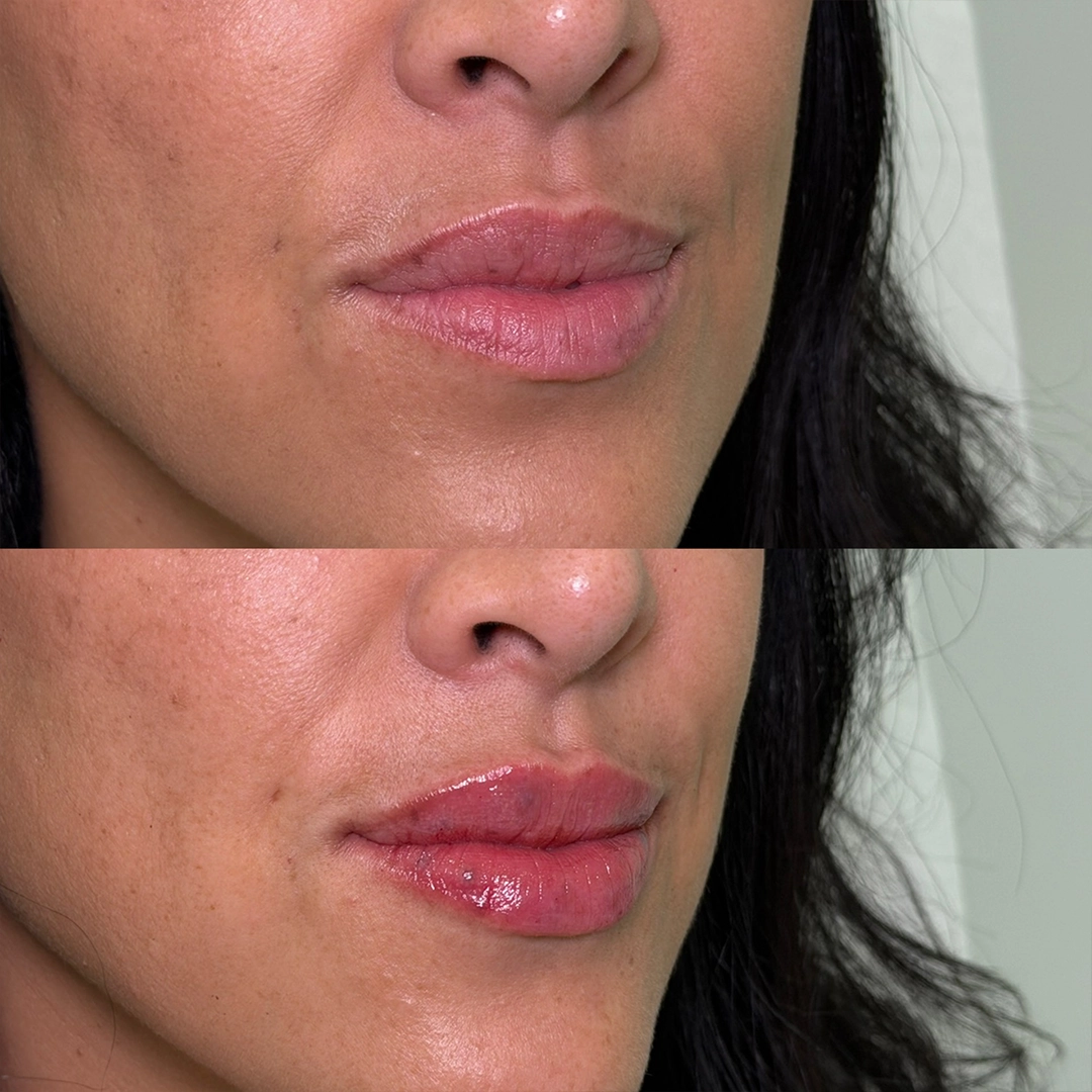 Dermal Filler 37 Lip Filler Before & After 17