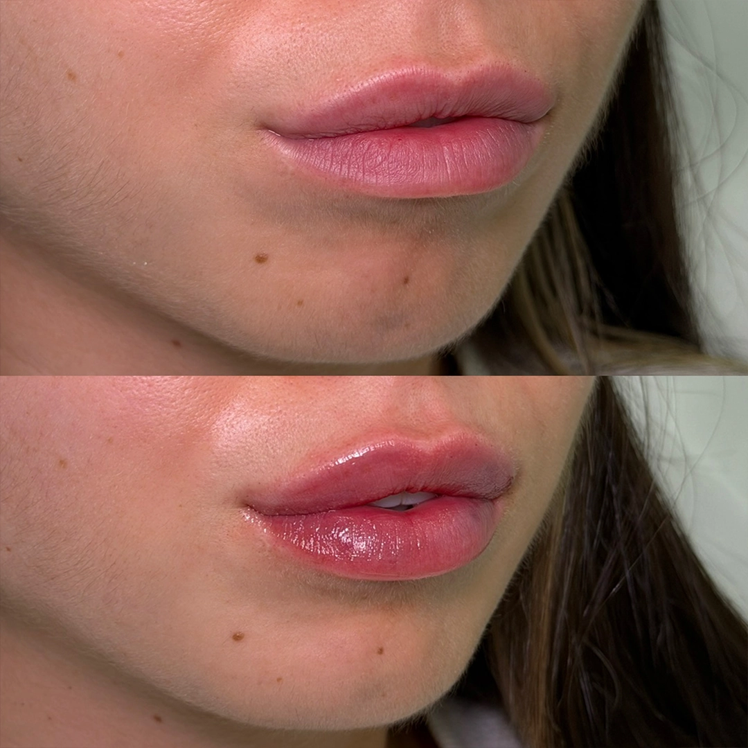 Dermal Filler 38 Lip Filler Before & After 18