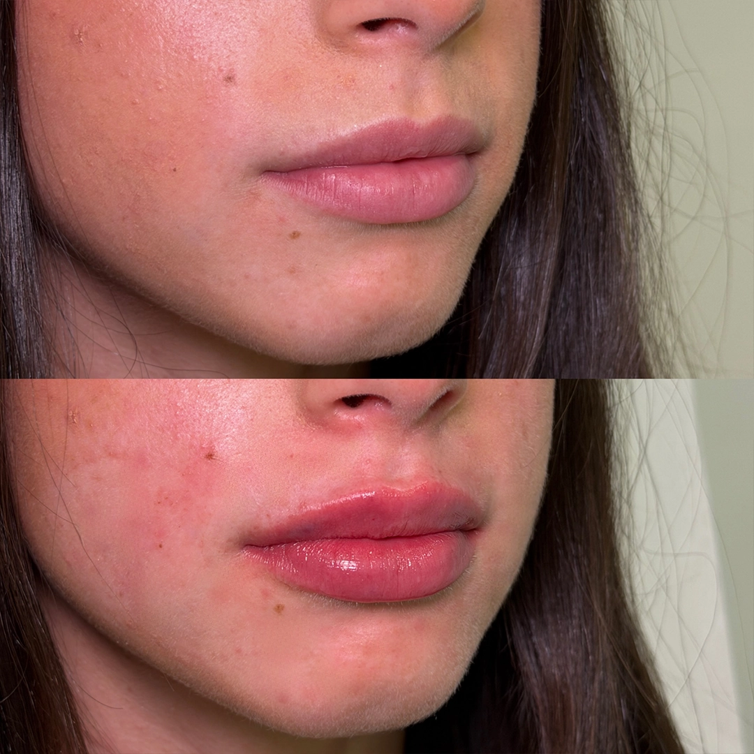 Dermal Filler 39 Lip Filler Before & After 19