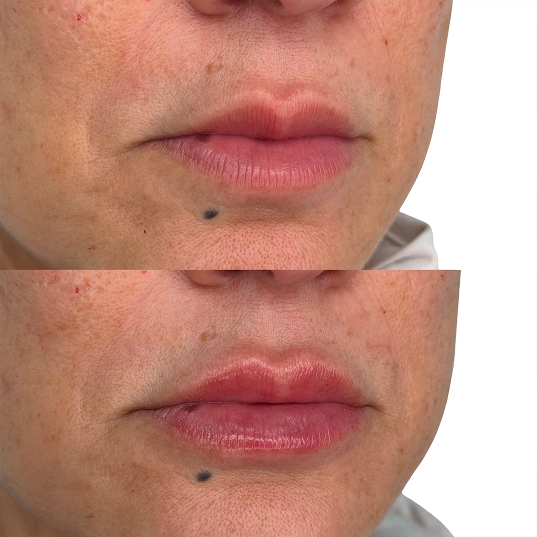 Dermal Filler 22 Lip Filler Before & After 2