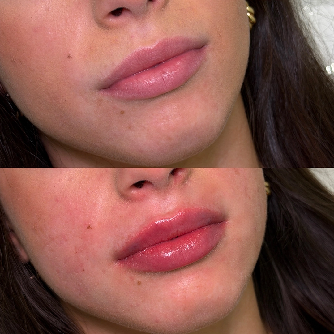 Dermal Filler 40 Lip Filler Before & After 20