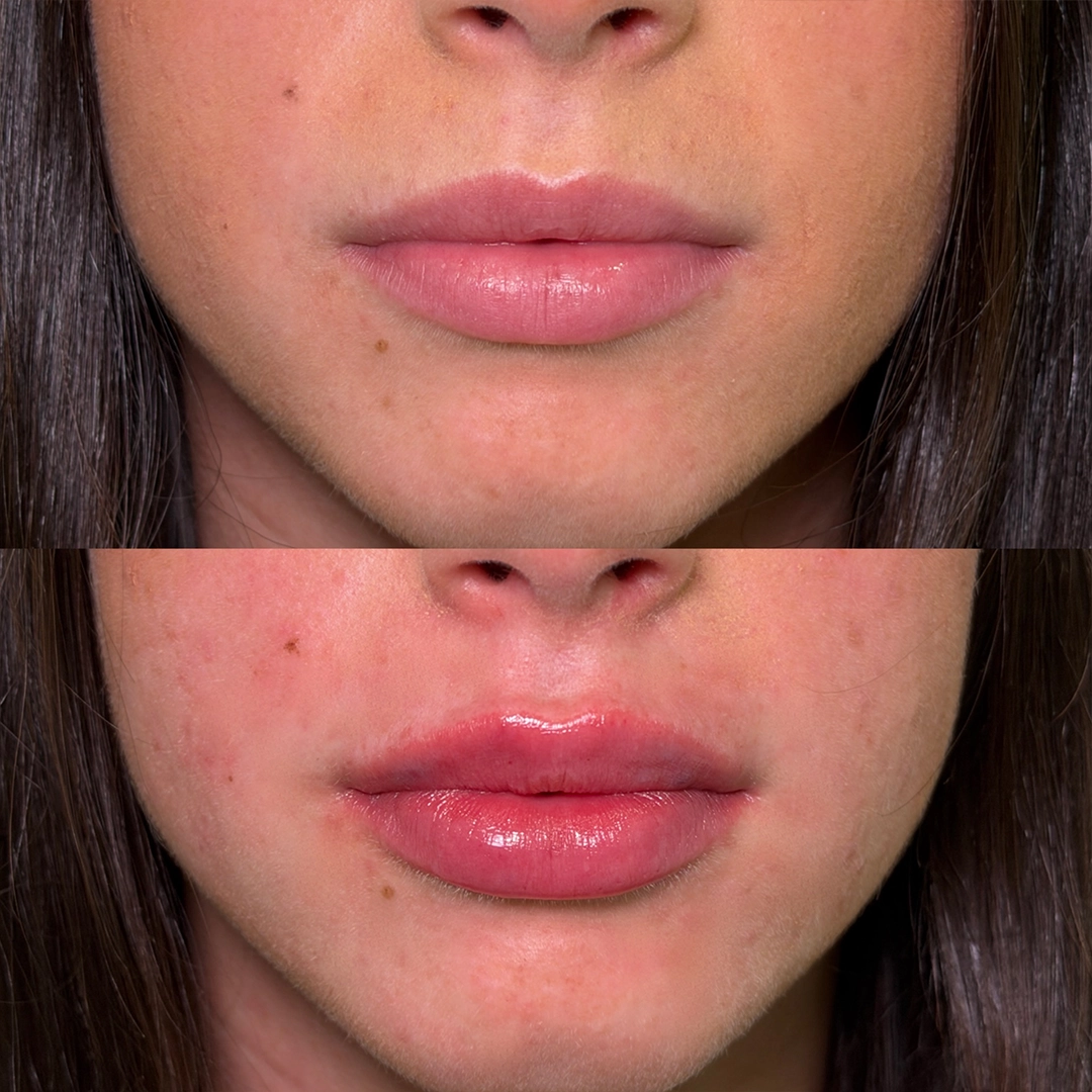 Dermal Filler 41 Lip Filler Before & After 21