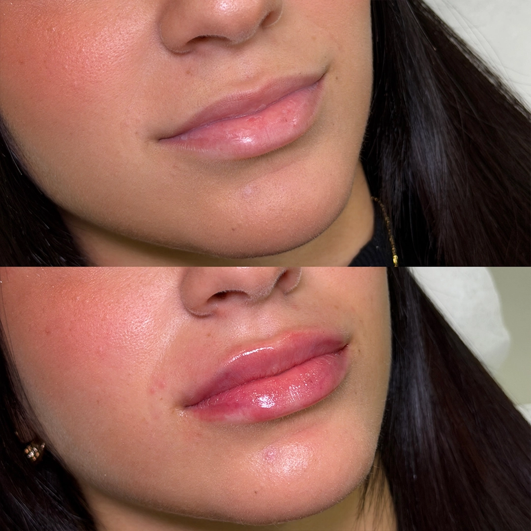 Dermal Filler 42 Lip Filler Before & After 22