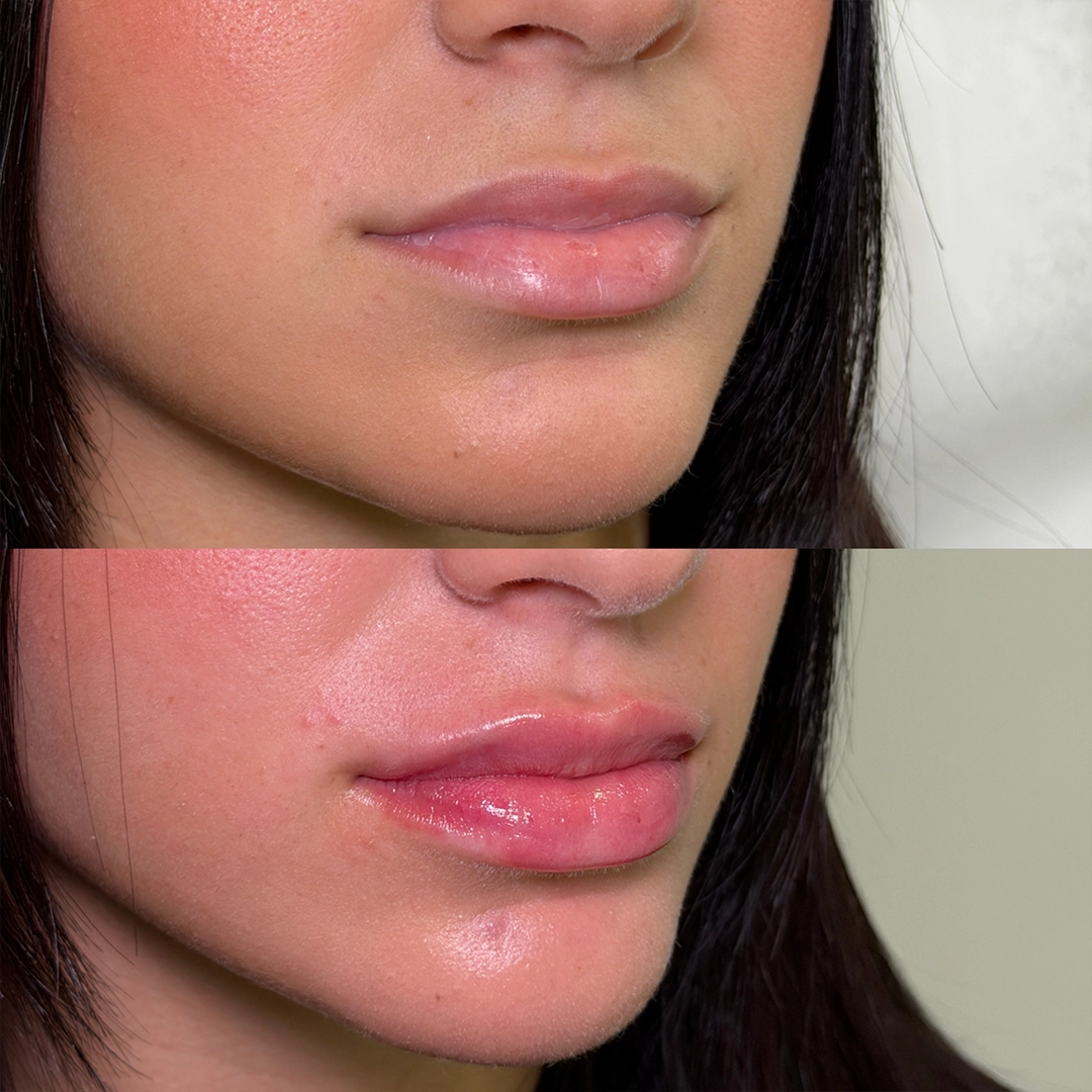 Dermal Filler 43 Lip Filler Before & After 23
