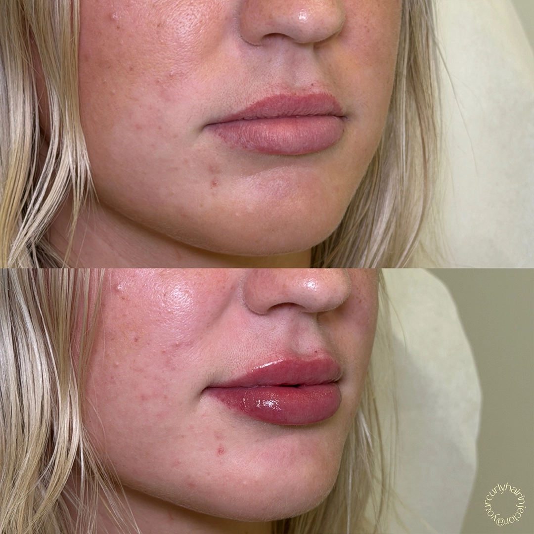 Dermal Filler 44 Lip Filler Before & After 24