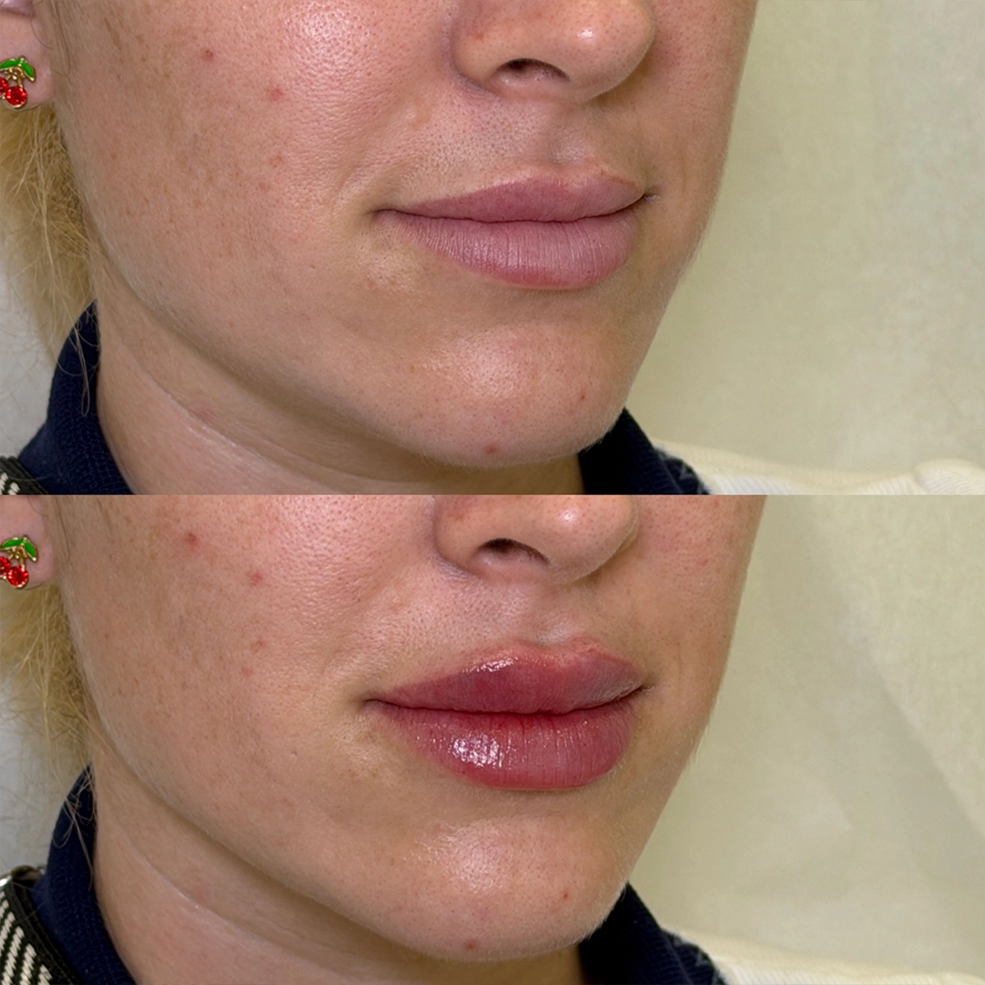 Dermal Filler 45 Lip Filler Before & After 25