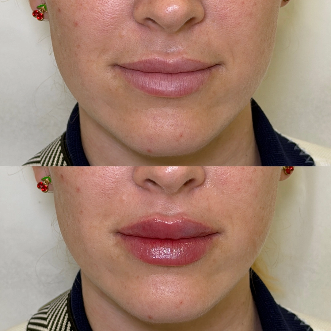 Dermal Filler 46 Lip Filler Before & After 26