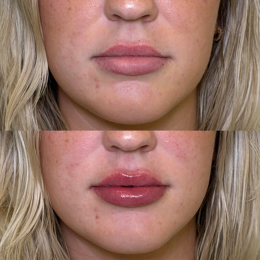 Dermal Filler 47 Lip Filler Before & After 27
