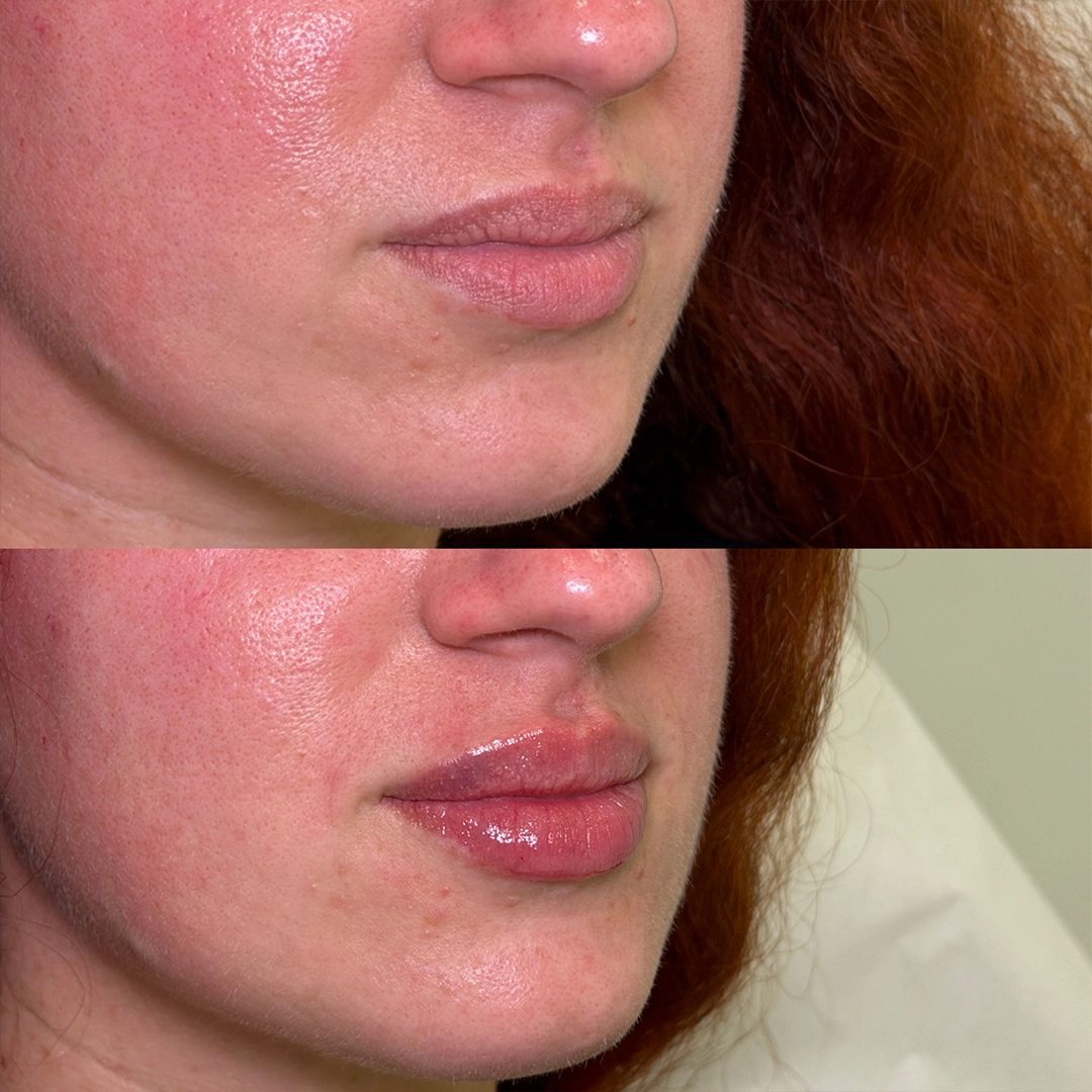 Dermal Filler 48 Lip Filler Before & After 28