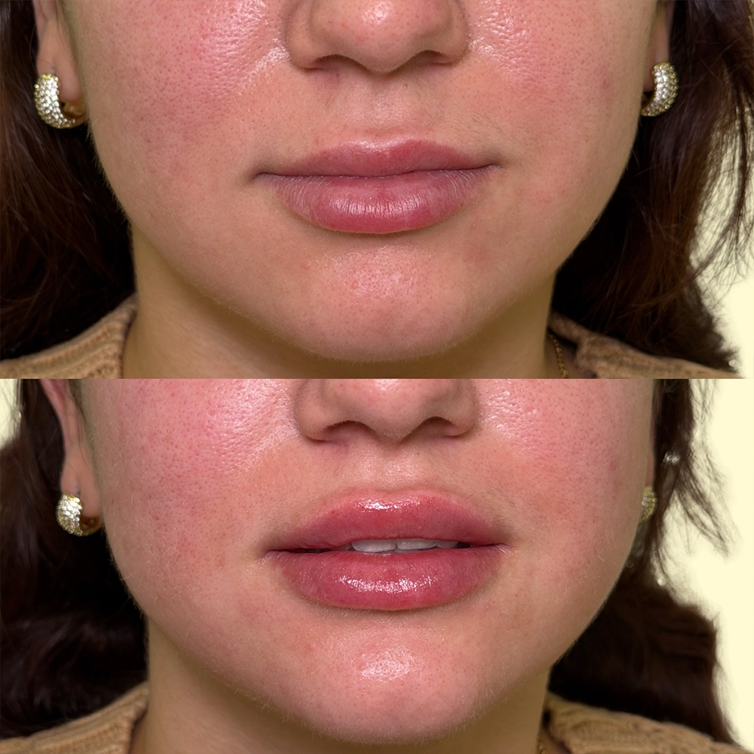 Dermal Filler 49 Lip Filler Before & After 29