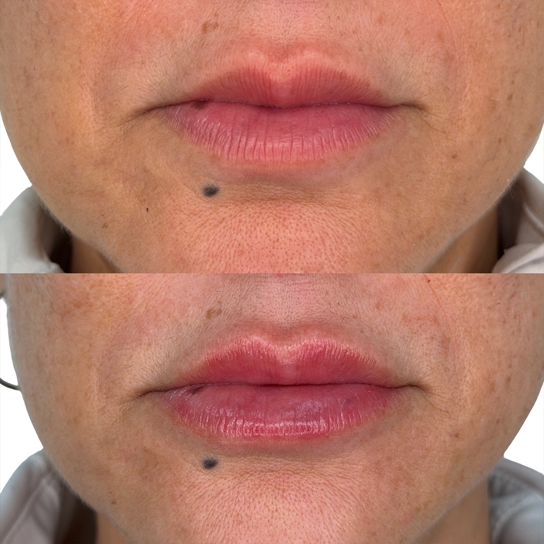 Dermal Filler 23 Lip Filler Before & After 3
