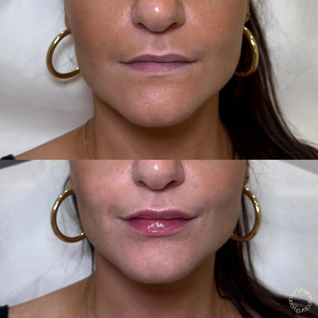 Dermal Filler 50 Lip Filler Before & After 30