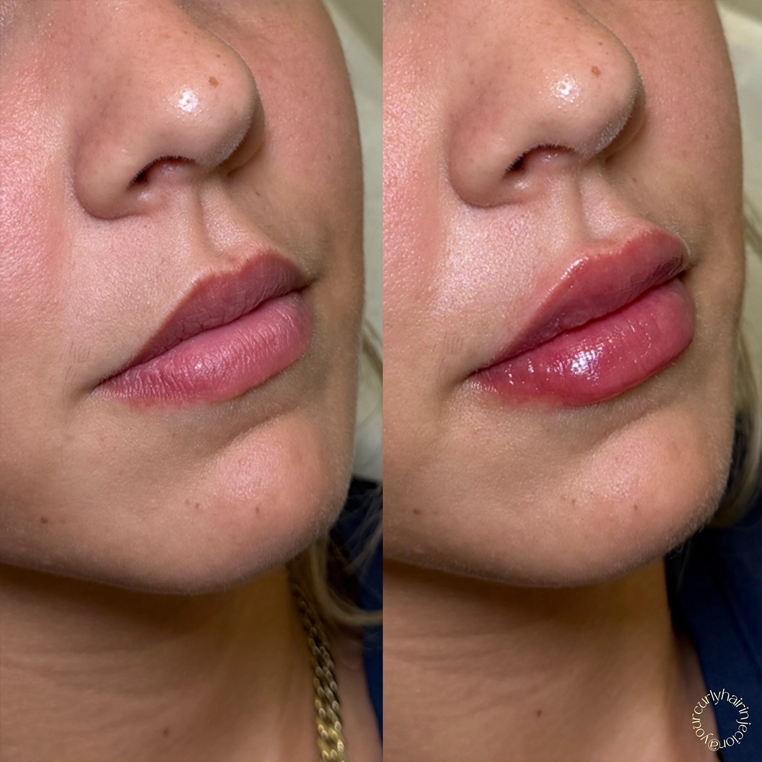 Dermal Filler 51 Lip Filler Before & After 31