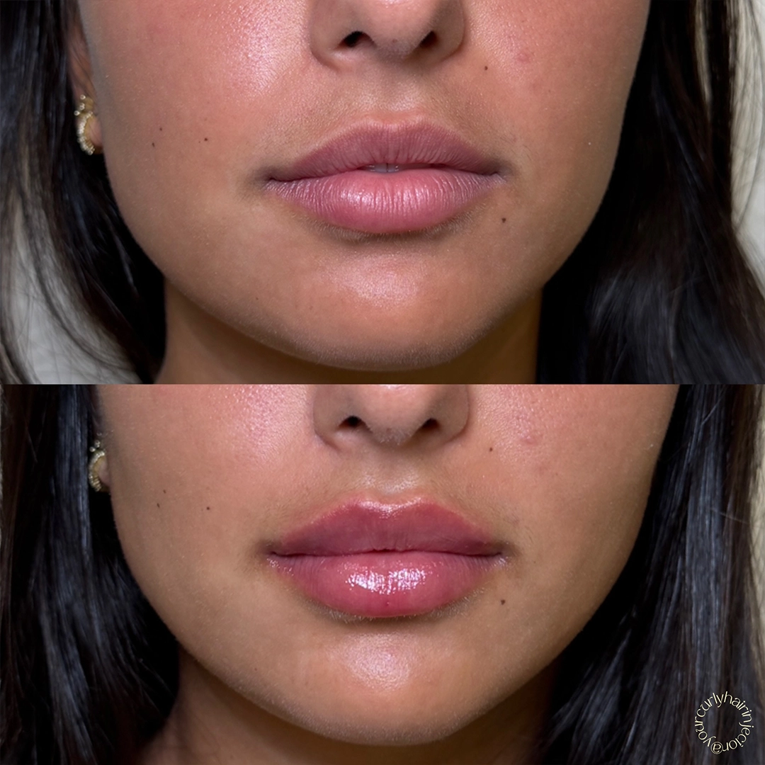Dermal Filler 52 Lip Filler Before & After 32