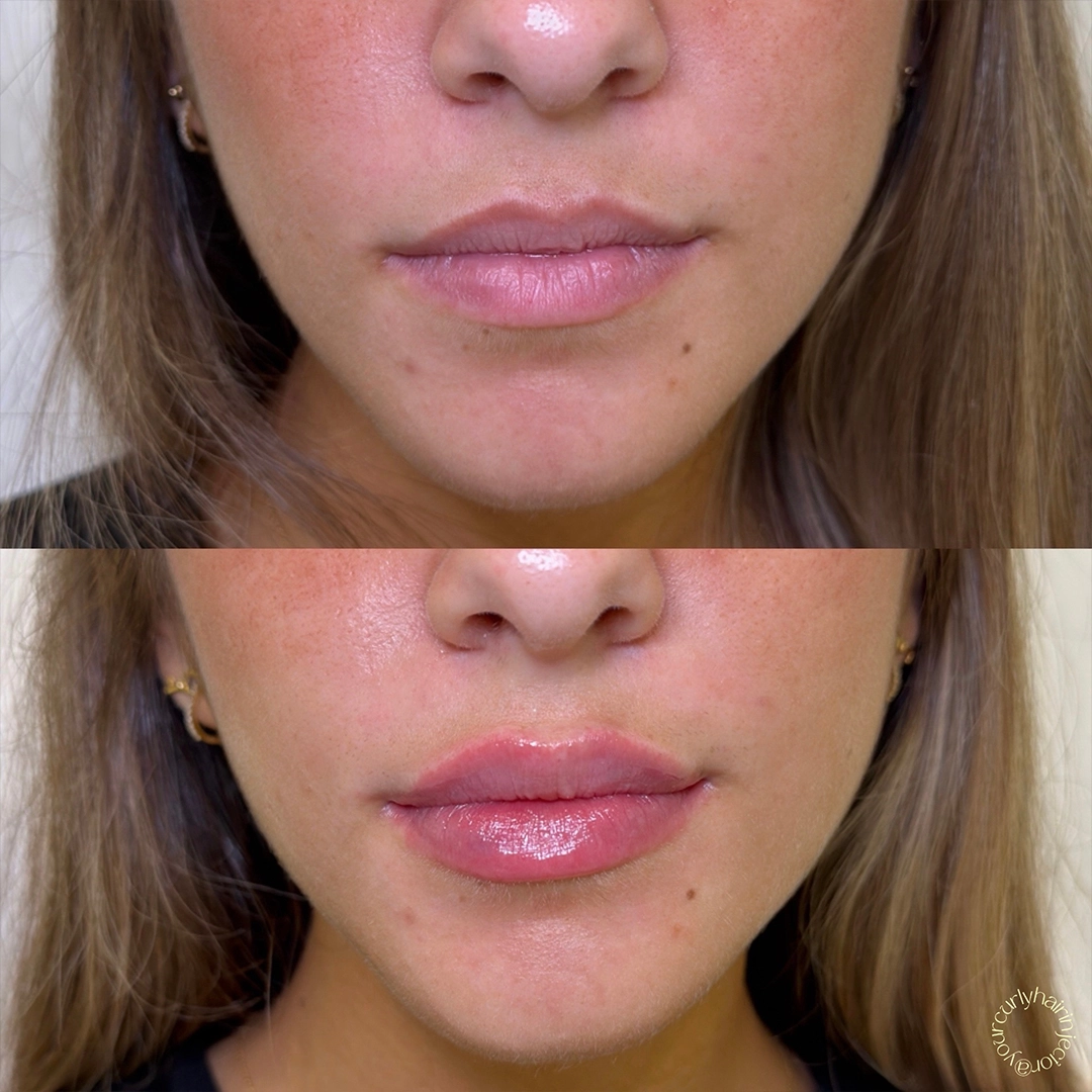 Dermal Filler 53 Lip Filler Before & After 33