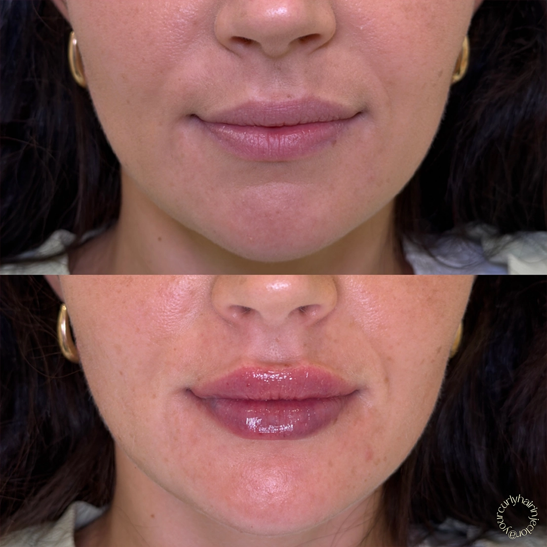 Dermal Filler 54 Lip Filler Before & After 34