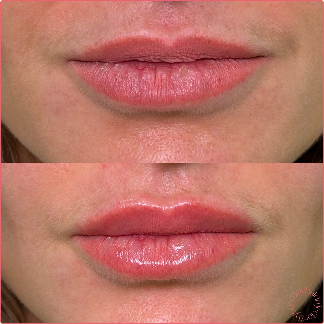 Dermal Filler 55 Lip Filler Before & After 35