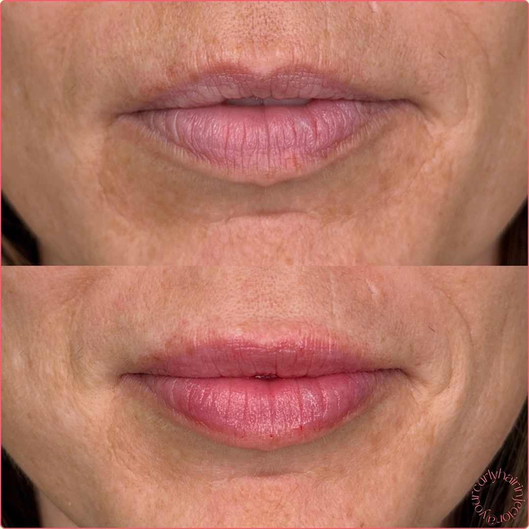 Dermal Filler 56 Lip Filler Before & After 36
