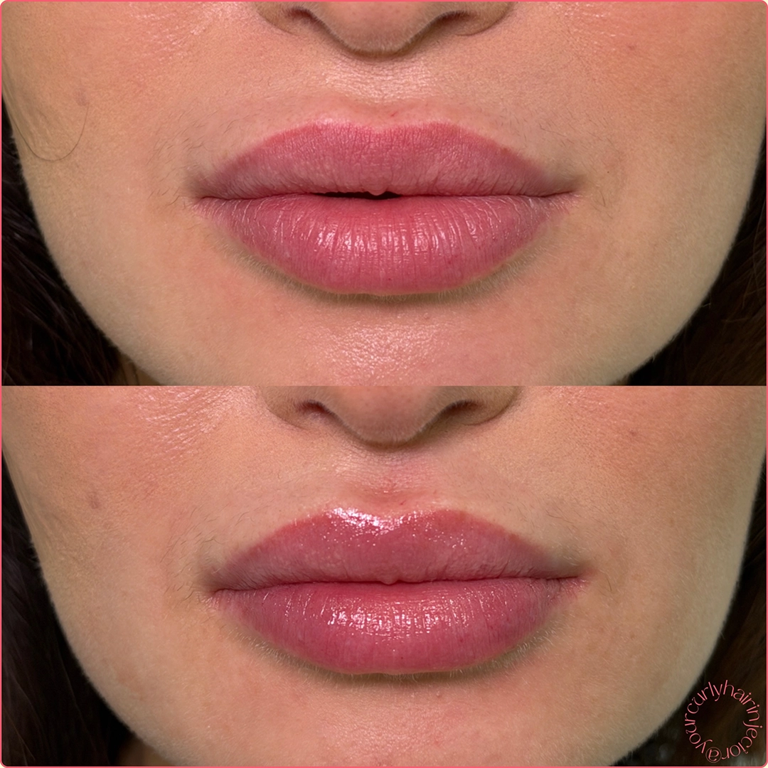 Dermal Filler 57 Lip Filler Before & After 37