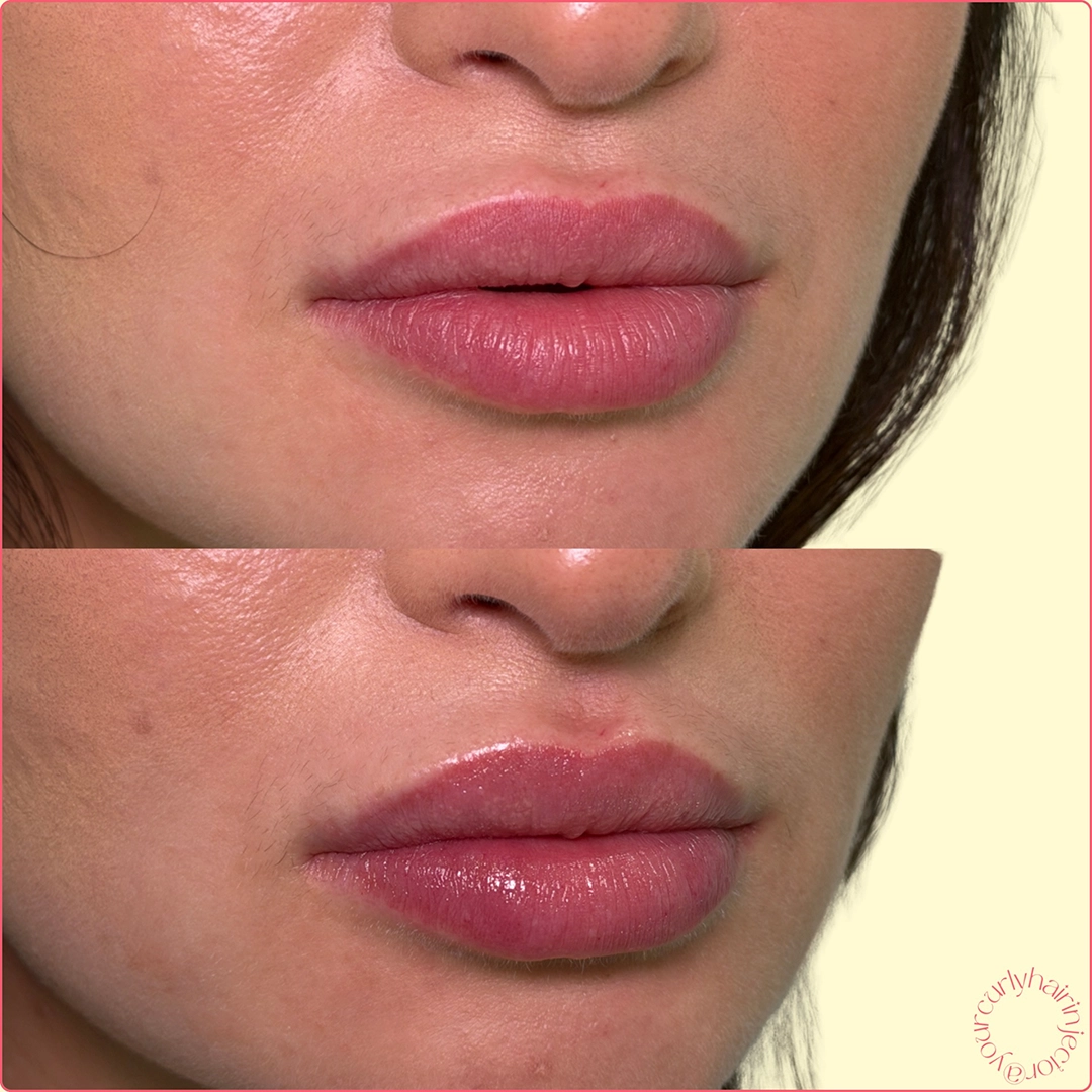 Dermal Filler 58 Lip Filler Before & After 38