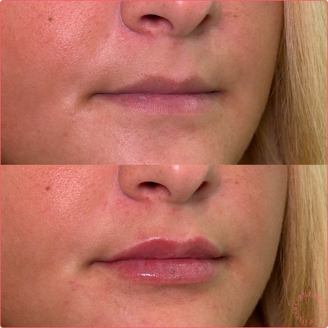 Dermal Filler 59 Lip Filler Before & After 39