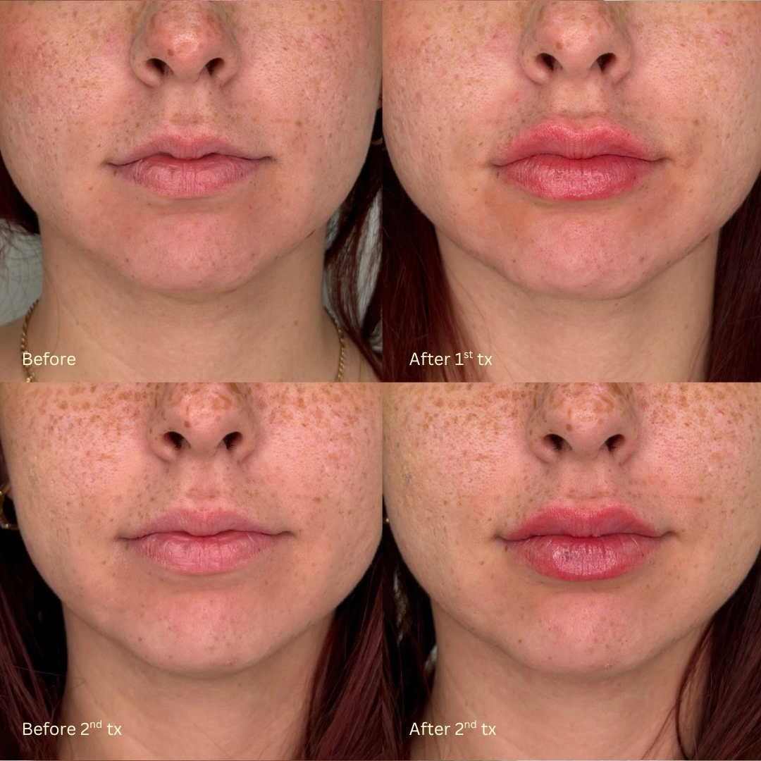 Dermal Filler 24 Lip Filler Before & After 4
