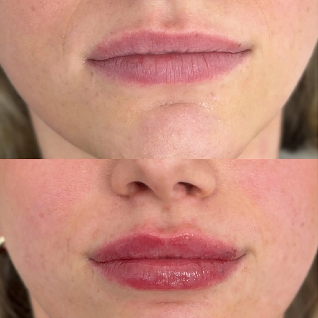 Dermal Filler 60 Lip Filler Before & After 40