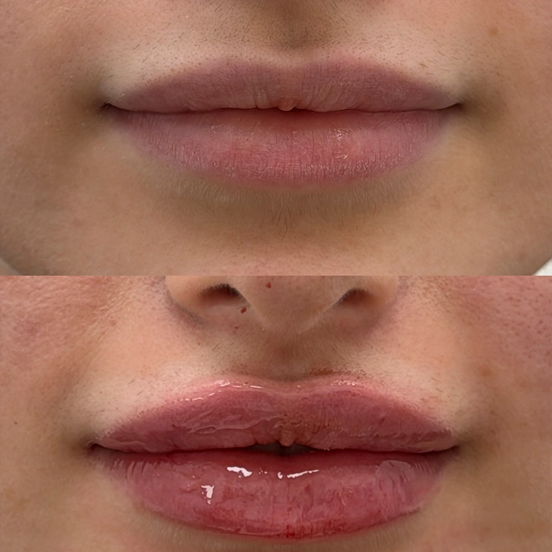 Dermal Filler 61 Lip Filler Before & After 41