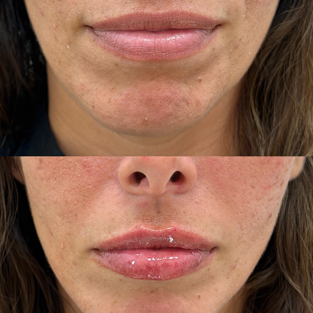 Dermal Filler 62 Lip Filler Before & After 42