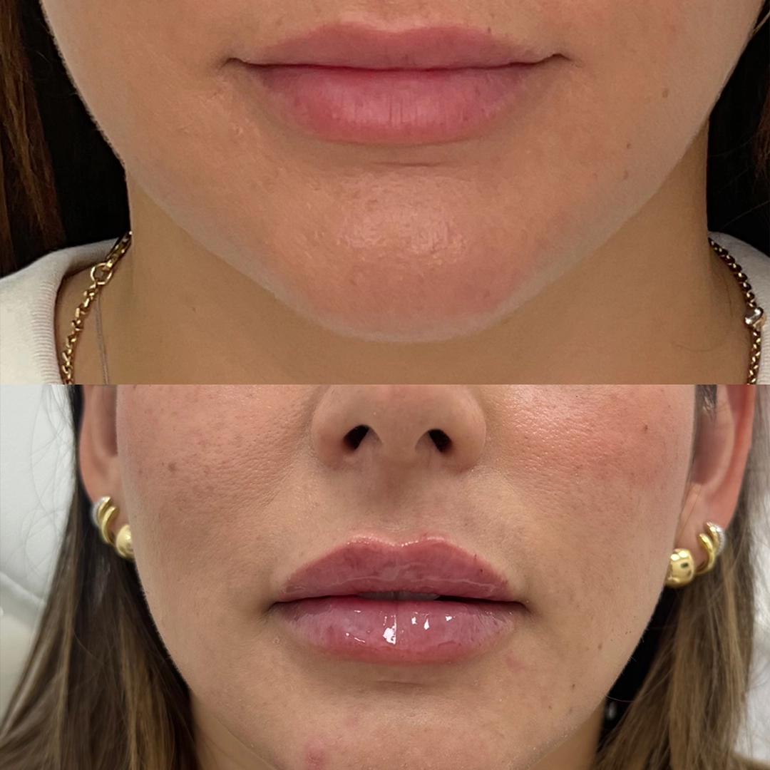 Dermal Filler 63 Lip Filler Before & After 43