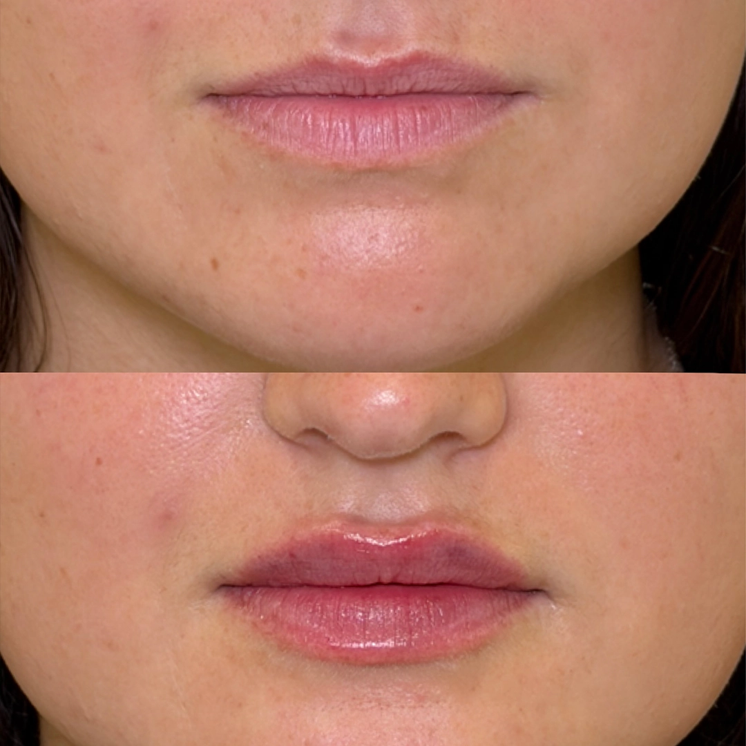 Dermal Filler 64 Lip Filler Before & After 44