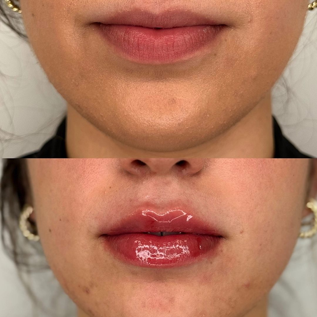 Dermal Filler 65 Lip Filler Before & After 45