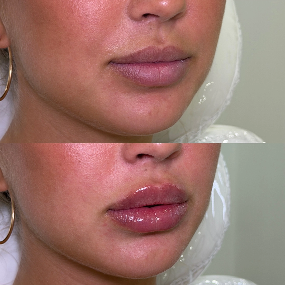 Dermal Filler 25 Lip Filler Before & After 5