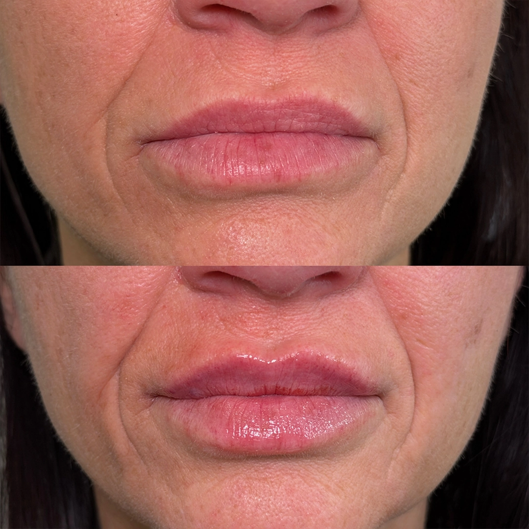 Dermal Filler 26 Lip Filler Before & After 6