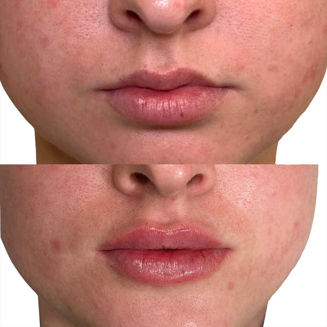 Dermal Filler 27 Lip Filler Before & After 7