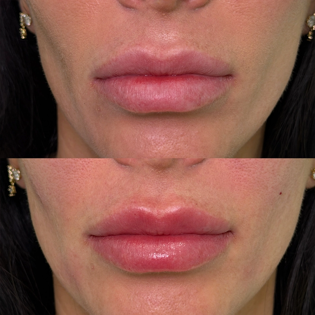 Dermal Filler 28 Lip Filler Before & After 8