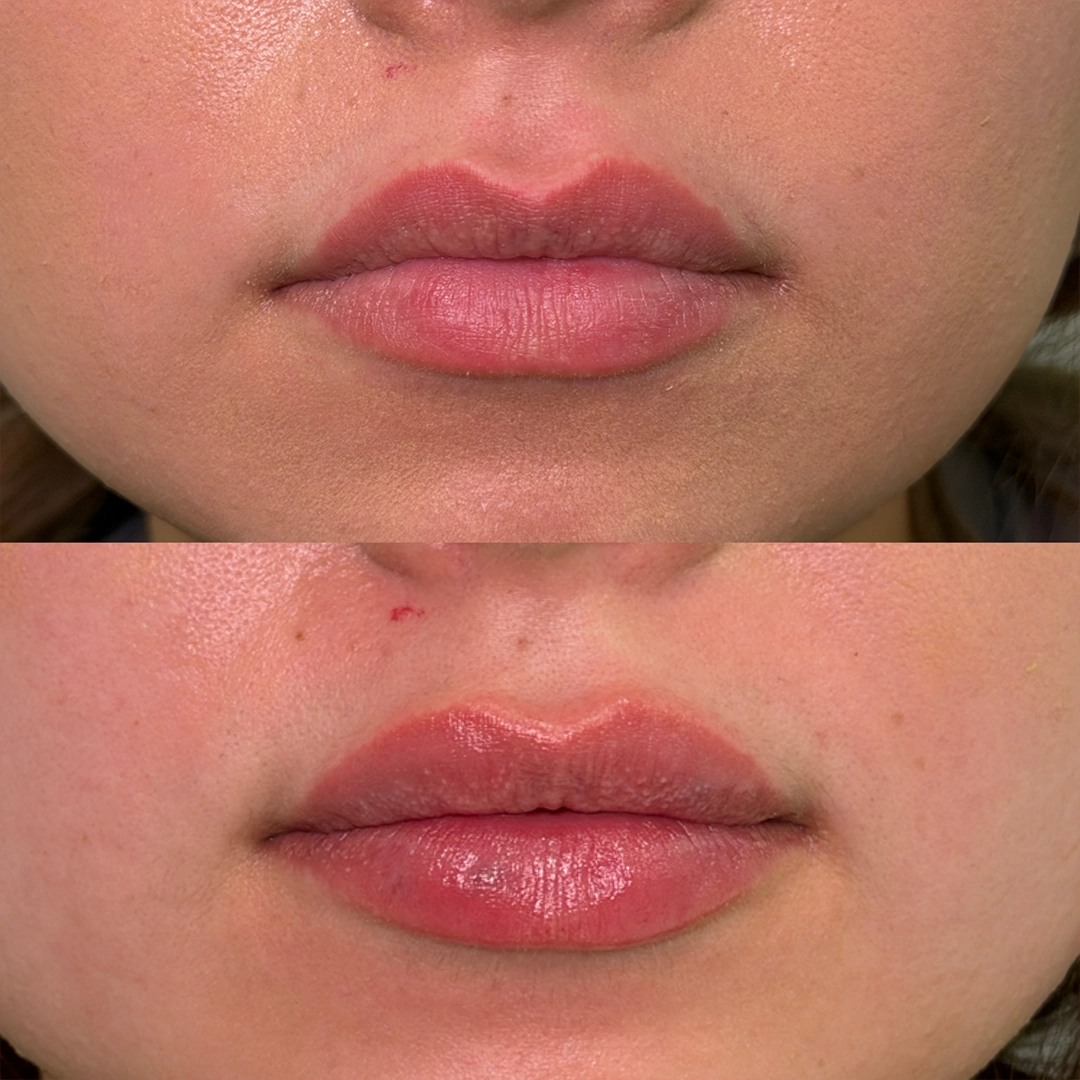 Dermal Filler 29 Lip Filler Before & After 9