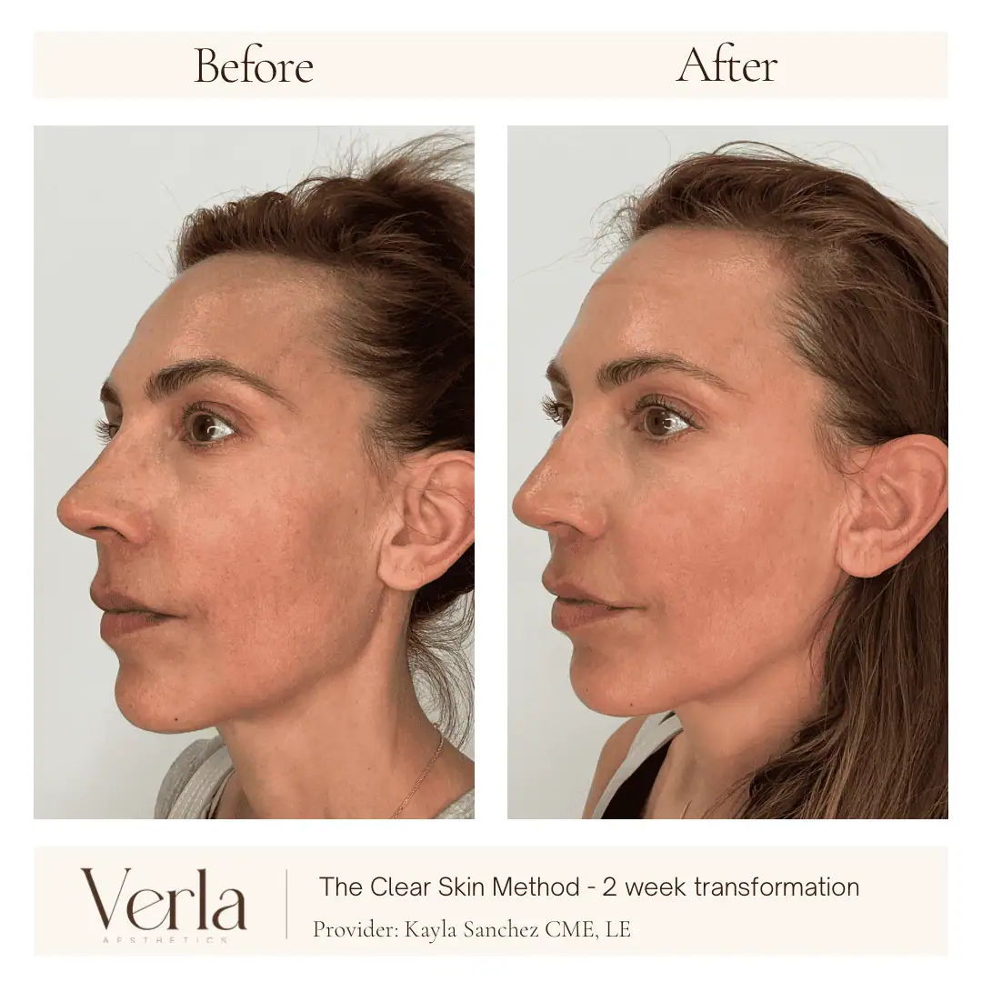 Home 1 Verla Before & After 1
