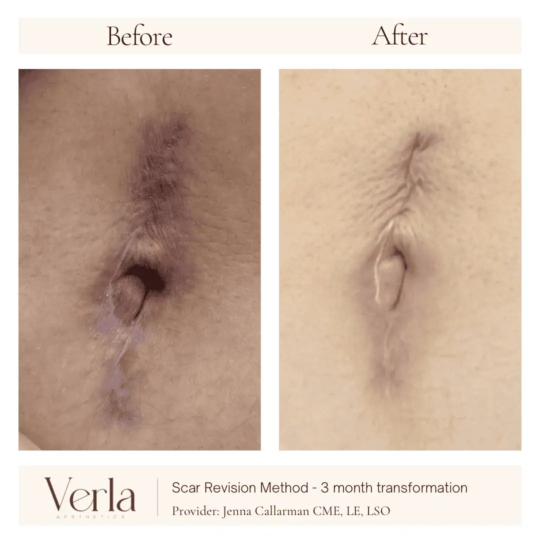 Home 14 Verla Before & After 14
