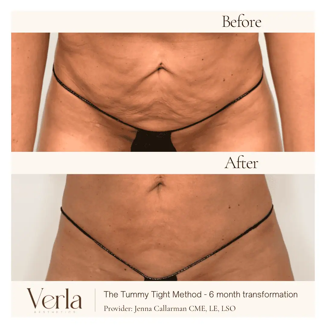 Home 15 Verla Before & After 15