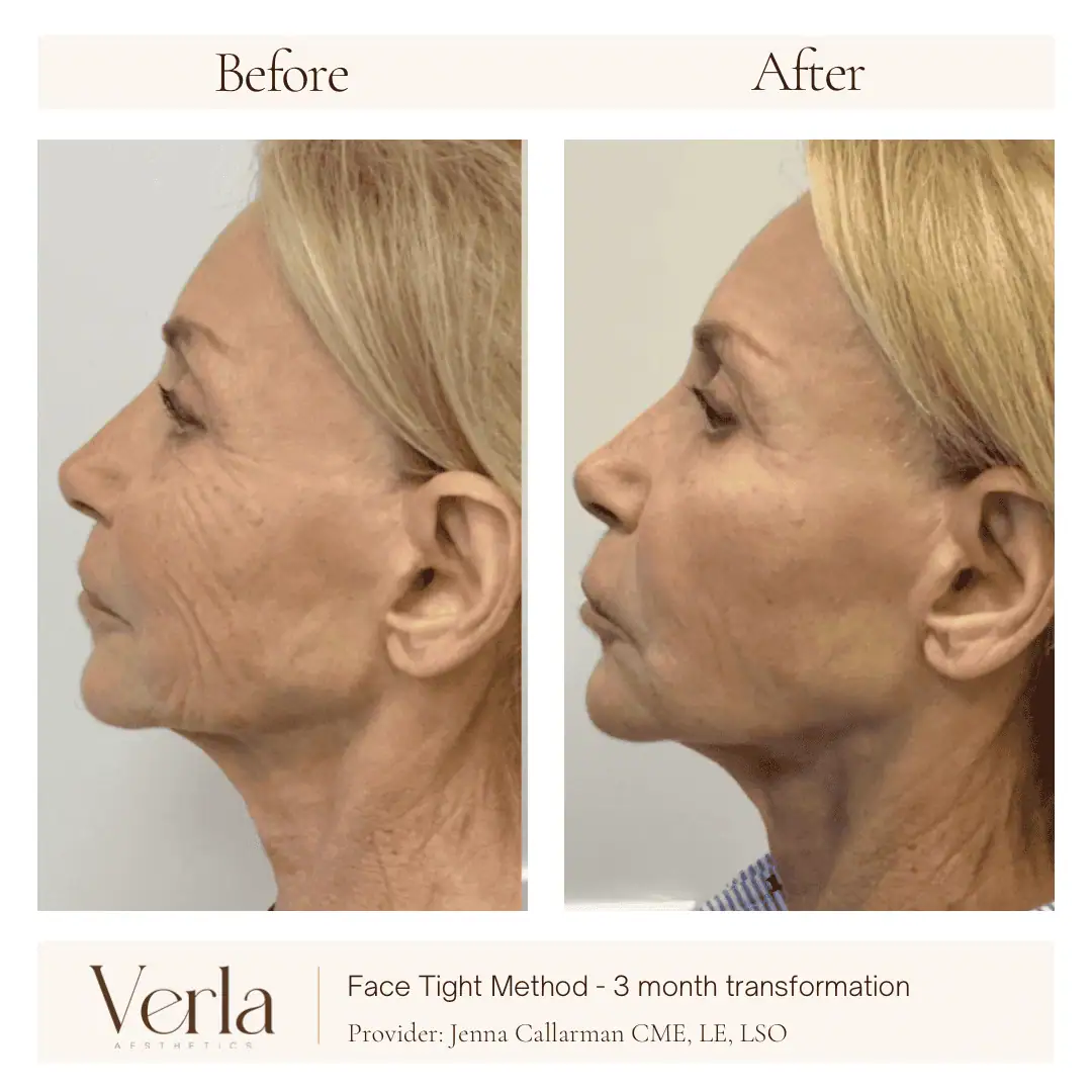 Home 2 Verla Before & After 2