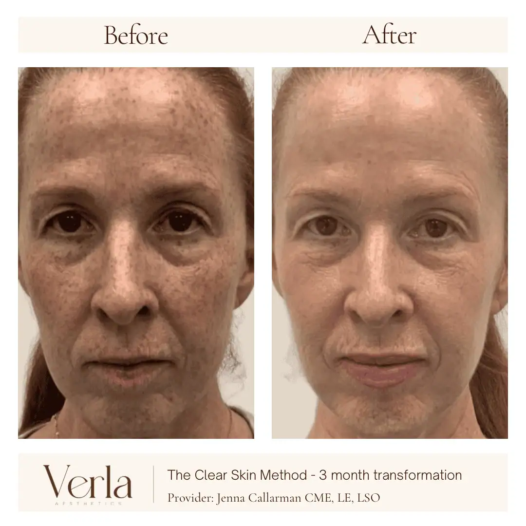 Home 4 Verla Before & After 4